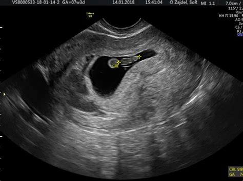 8 week pregnancy dating scan